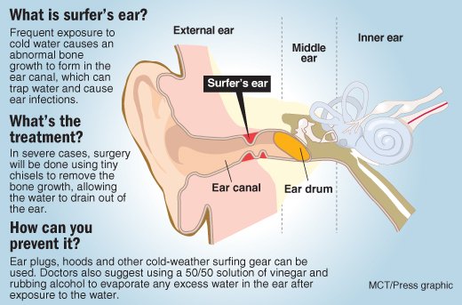 Surfers Custom Made Ear Plugs for $95. In stock Appointment required for fitting